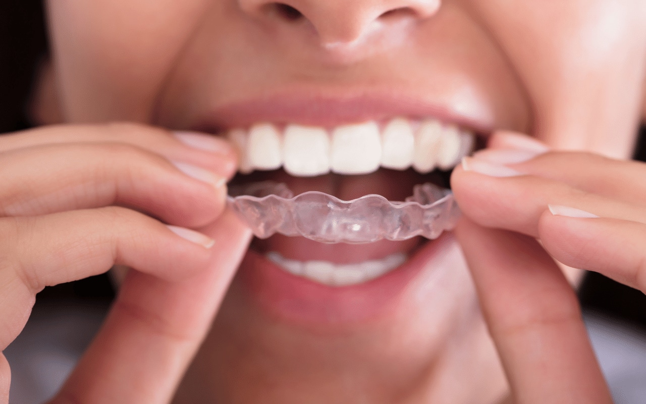 clear aligner treatment Lexington KY