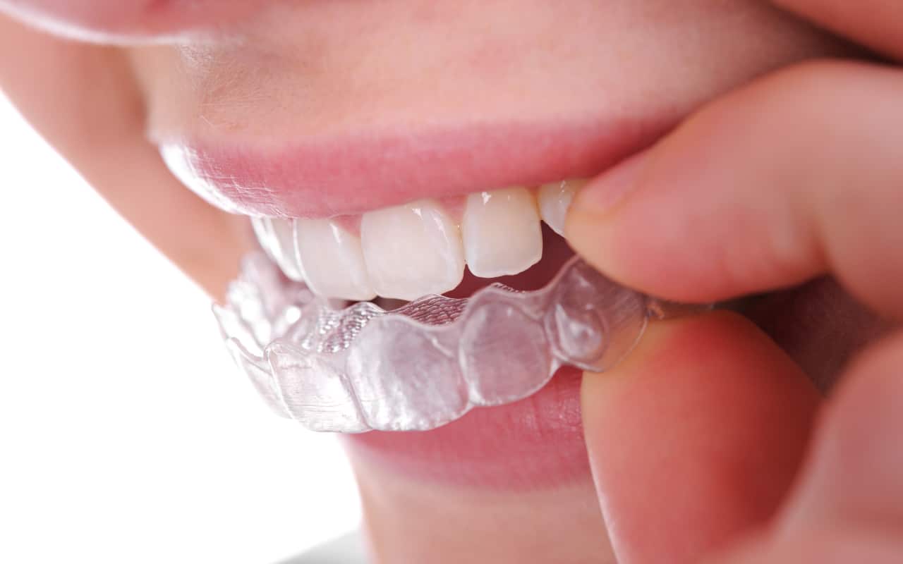 The Benefits of Clear Aligners