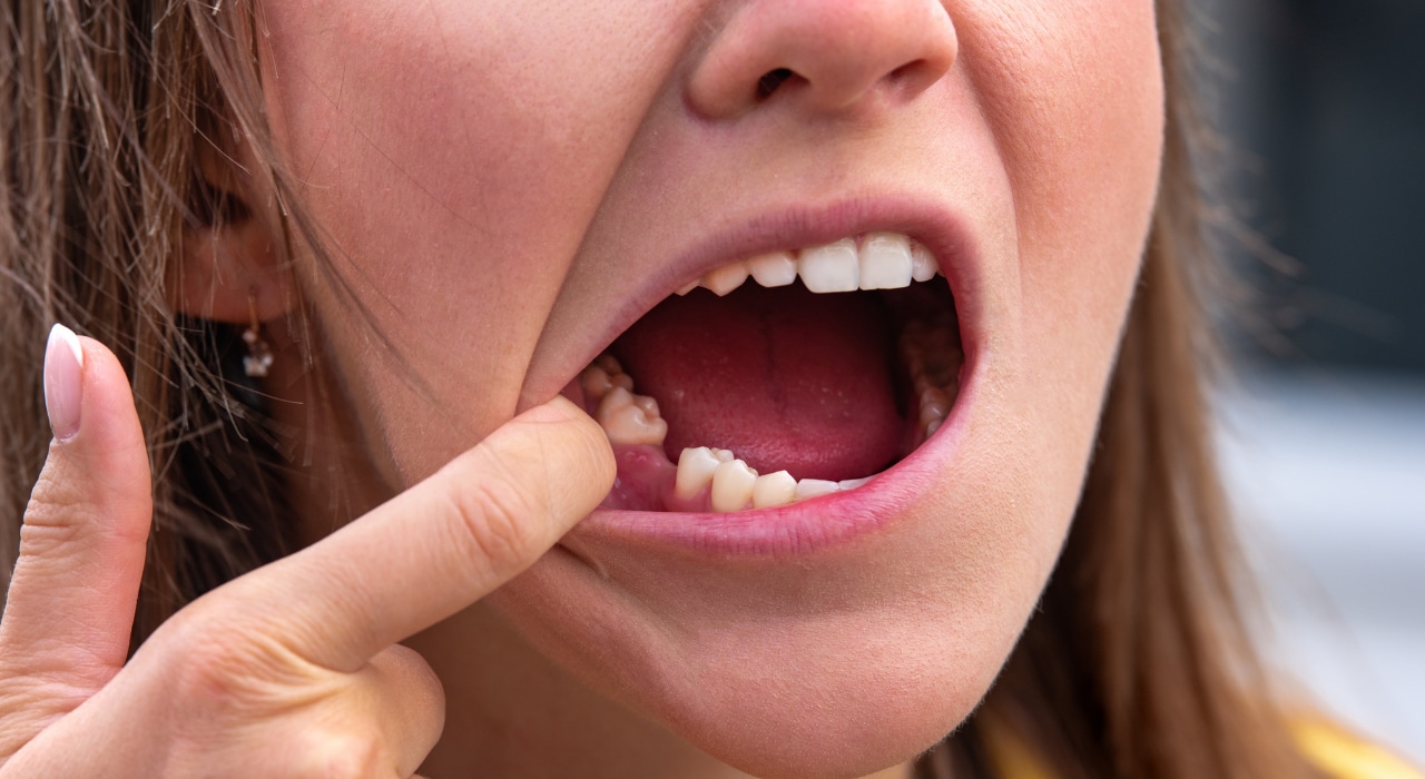 What To Do When A Back Tooth Falls Out