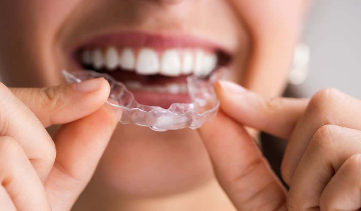 The Benefits of Clear Aligners