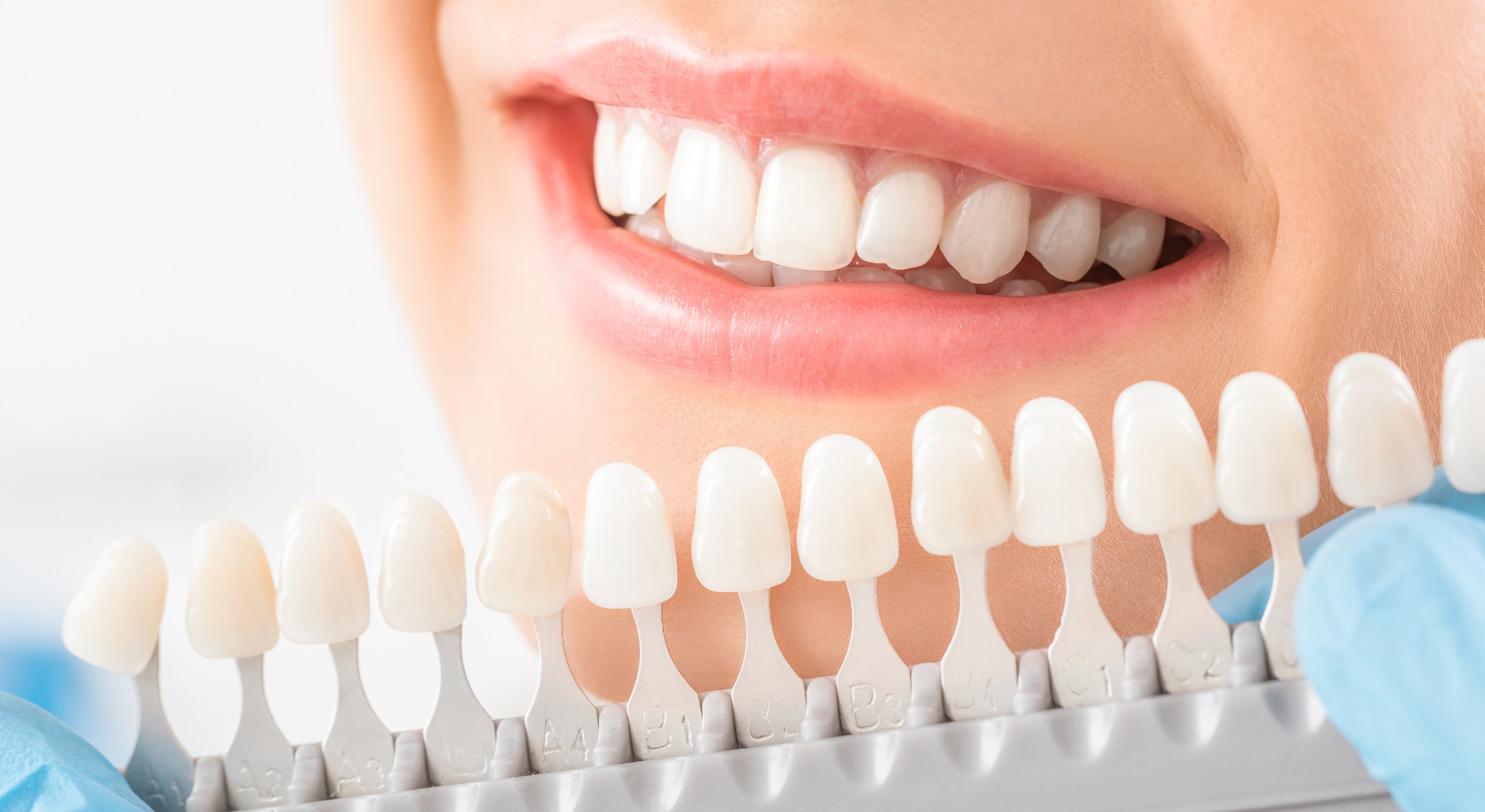 The Benefits of Lumineers for Your Smile