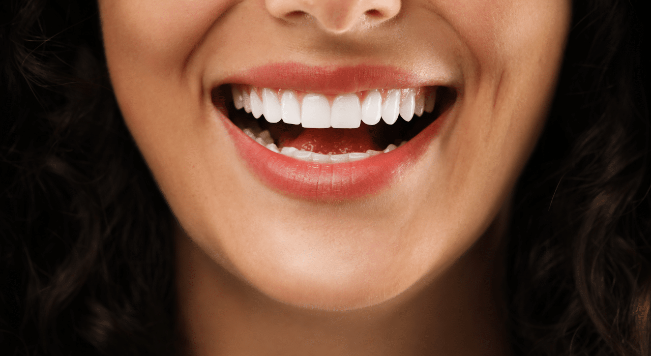 Everything You Need to Know About Porcelain Veneers Lexington Ky